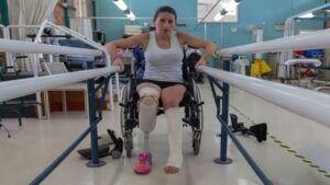 Close-Up of Broken Left Leg and New Prosthetic on Left with Limb Amputated Below the Knee